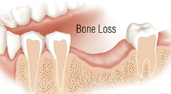 Dental Bone Grafting Pic