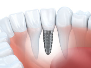 Dental Implant Picture