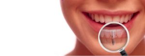 affordable-dental-implants