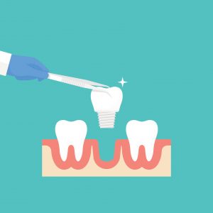 tooth-replacment-options