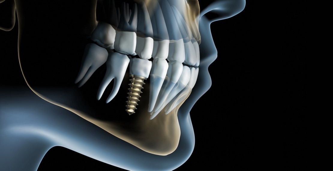 dental-implants