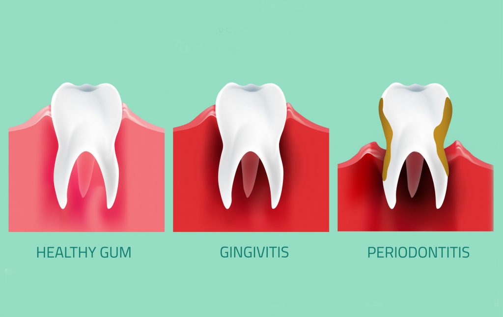 types of oral diseases