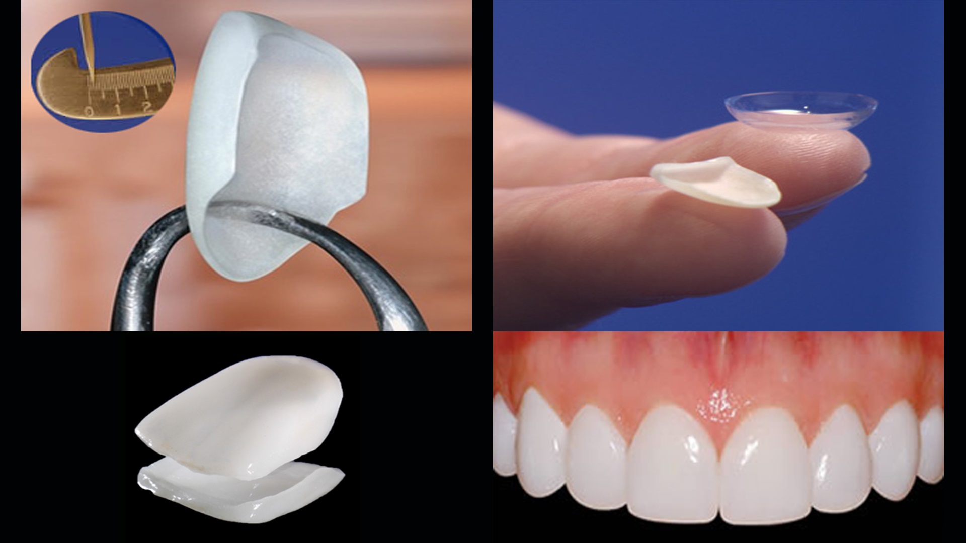 Porcelain Teeth Veneers