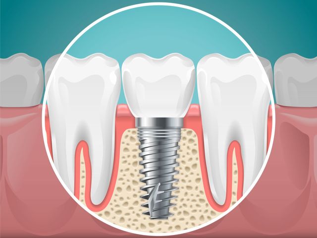 Tooth Replacement Option: Dental Implants Can Restore Your Smile